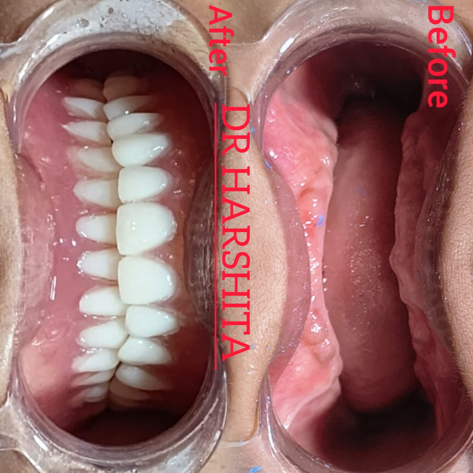 Before & After - Hair Transplant